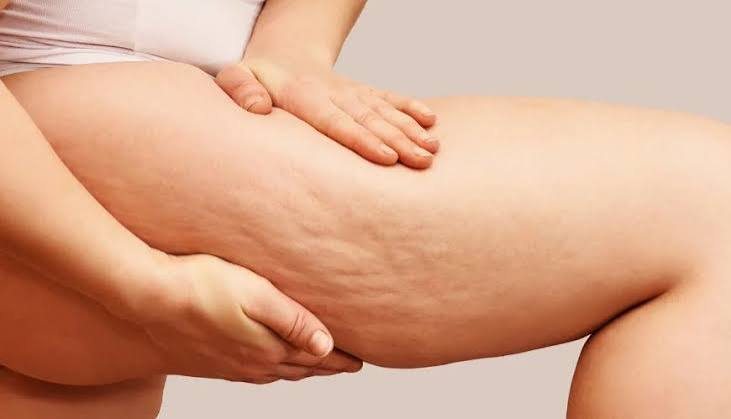 Illustration : lipœdème des jambes